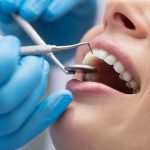 How Dental Implants Can Improve Your Smile