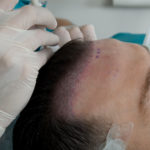 How Baldness Issue Can Be Permanently Removed By Hair Transplant?