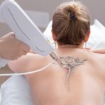 The Ins And Outs Of Tattoo Removal